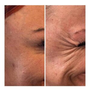 Advanced Botulinum Toxin