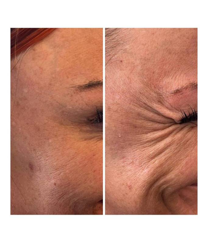 Advanced Botulinum Toxin