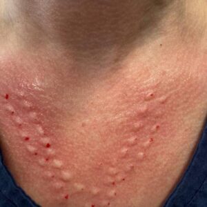Chemical Peels