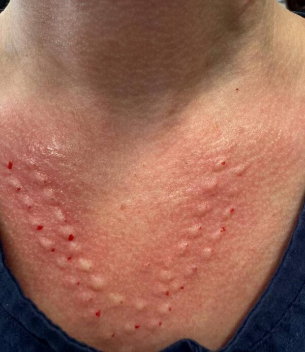Chemical Peels