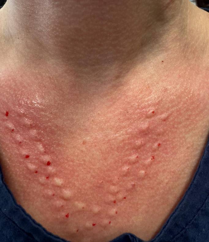 Chemical Peels